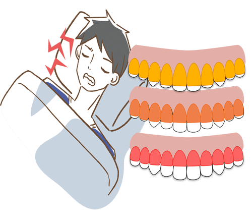 Bruxismul: copiii pot avea bruxism?